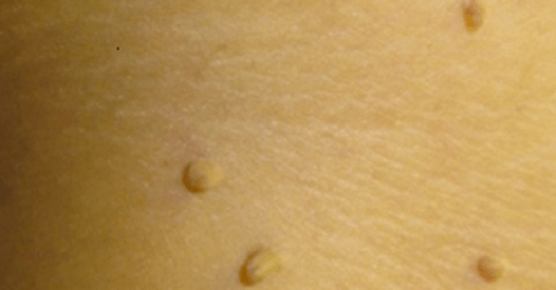 10 Natural Remedies to Remove Warts