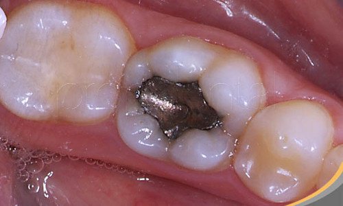 The Health Risks of Dental Amalgam Fillings