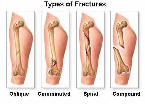 5 Primary Bone Cancer Symptoms You Should Know