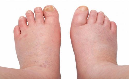 6 Remedies for Swelling in Your Ankles, Feet and Legs