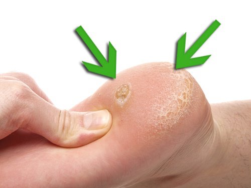 remedies for foot calluses and corns
