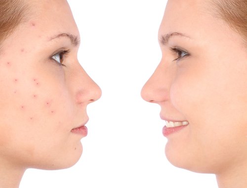 Before and after acne