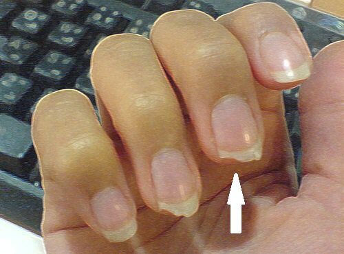 broken nails