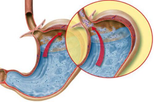 6 Remedies That May Help Stop Acid Reflux