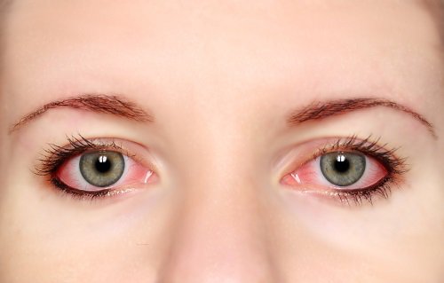 Benefits of consuming cilantro conjunctivitis pink eyes closeup