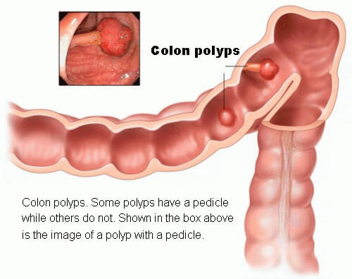 Colon polyp with a pedicle