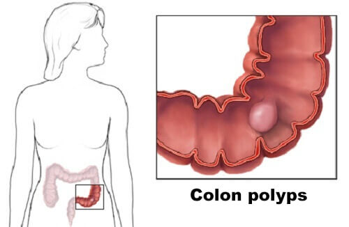 Colon Polyps: Learn The Facts Here