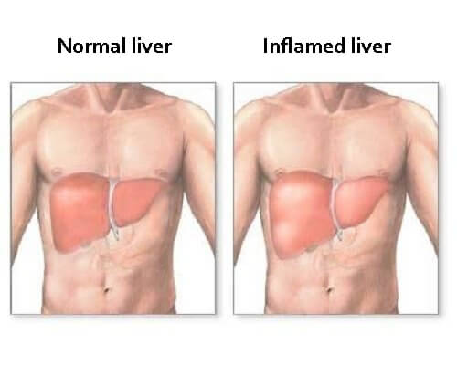 Liver Inflammation Symptoms and Diet