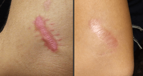 How to Naturally Reduce the Appearance of Scars