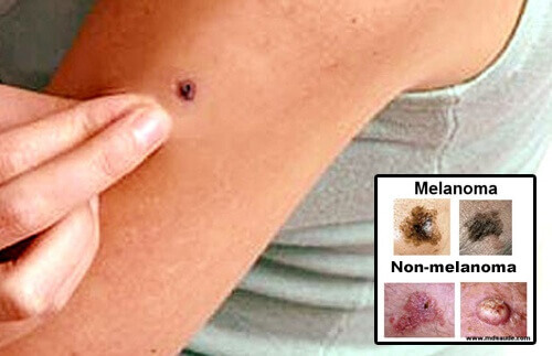 Skin Cancer: Warning Signs, Causes And Symptoms