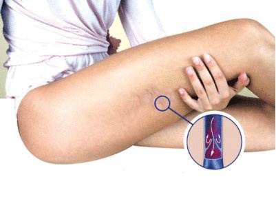 symptoms of a blood clot in the legs