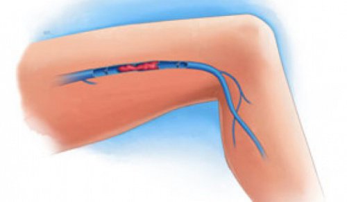 Symptoms of a Blood Clot in the Legs