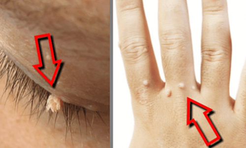 Remove Warts Naturally Remove Warts Naturally