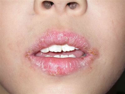 Cracks in the mouth