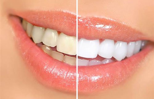 8 Foods That May Cause Yellow Teeth