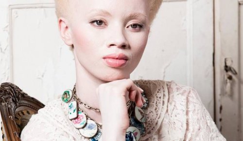 Albinism The Moving Story Of Model Thando Hopa