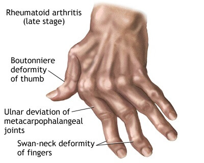 7 Natural Remedies for Arthritis in the Hands