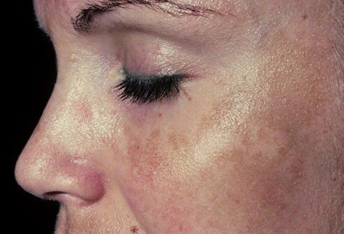 Do You Have Dark Spots? Try These 6 Remedies!