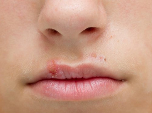 How to Stop a Cold Sore Fast with Natural Remedies
