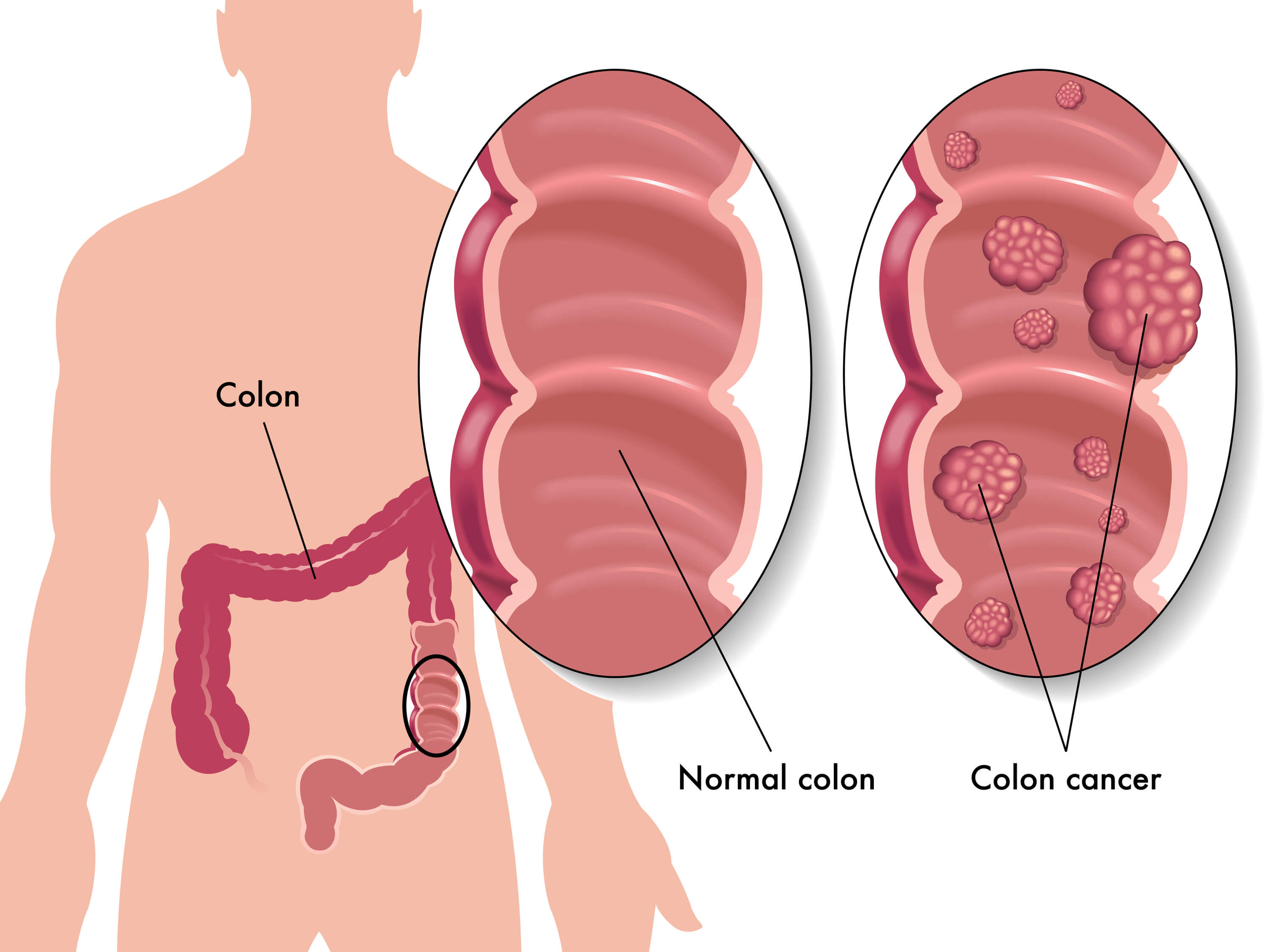 5 Tips to Help Prevent Colon Cancer 5 Tips to Help Prevent Colon Cancer