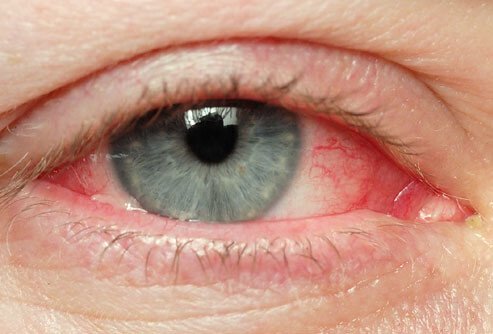 Natural Ways to Soothe Irritated Eyes