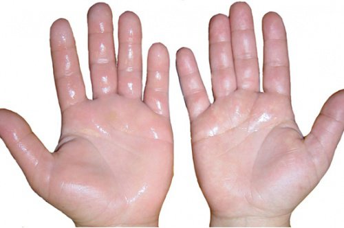 6 Home Remedies for Swollen Hands