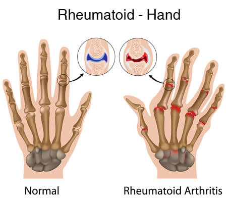 Diagram showing a normal hand vs a hand with rheumatoid arthritis