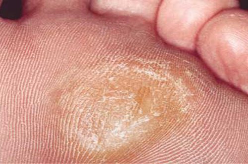 Learn How to Effectively Remove Callouses