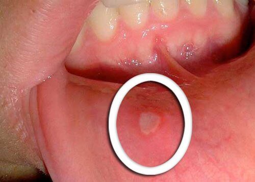 Close up of canker sore inside mouth natural remedies with avocado