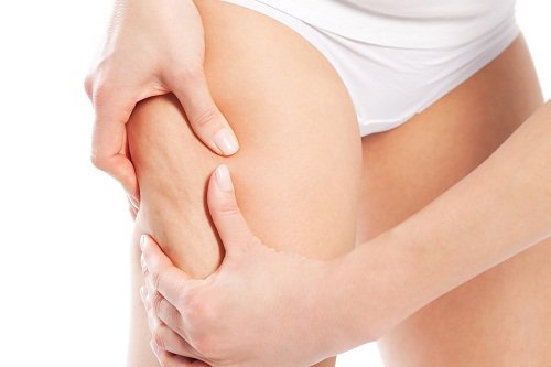 cellulitis