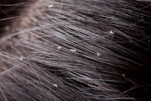 Hair scalp with dandruff