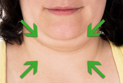 Double chin