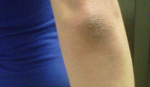 Natural Remedies for Dark Elbows and Knees