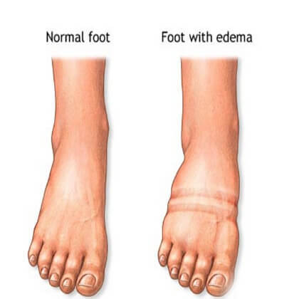 Fluid retention