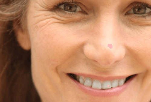 Facial exercises to look younger may work on wrinkles