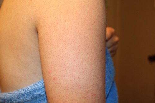 How to Erase Pimples on Your Arms