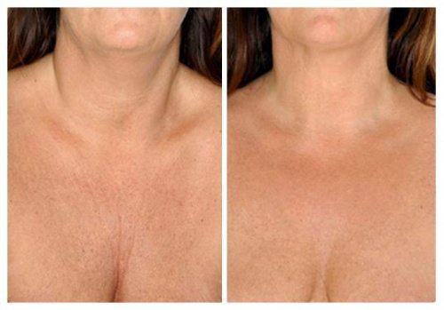 The Best Natural Neck Skin Care Treatments