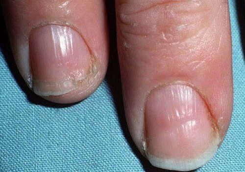 Damaged nails
