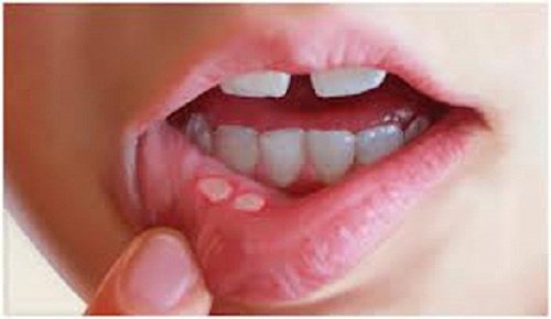 How to Naturally Treat Canker Sores