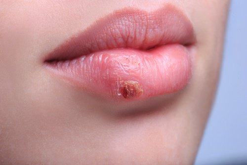 Why Do Cold Sores Come Back?