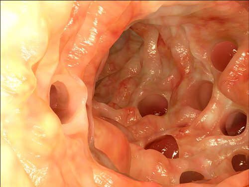 Diverticulitis and diverticulosis.