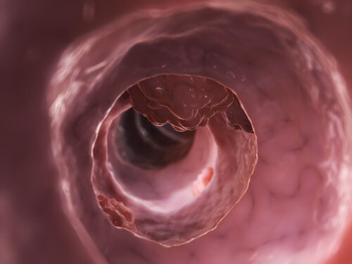 Diverticulosis or diverticulitis.