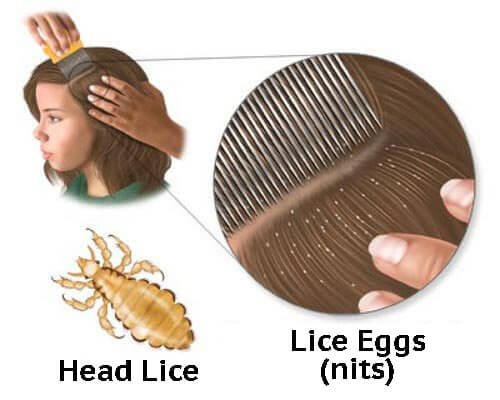 5 Homemade Remedies to Fight Lice