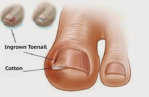Homemade Remedies to Treat Ingrown Toenails