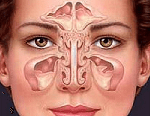 How to Treat Sinusitis in a Natural Way