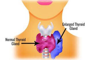 Thyroid disease hyperthyroidism causes weight loss and other symptoms