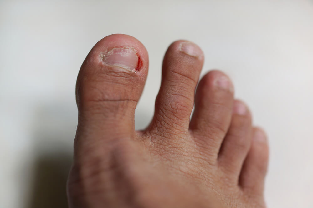 Homemade Remedies to Treat Ingrown Toenails - Step To Health
