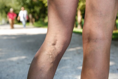 A leg with varicose veins.