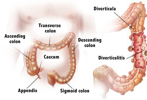 Diverticulitis and Diverticulosis: Diagnosis and Treatment