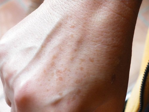 age spots